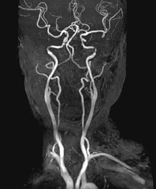 頭頸部動脈検査画像