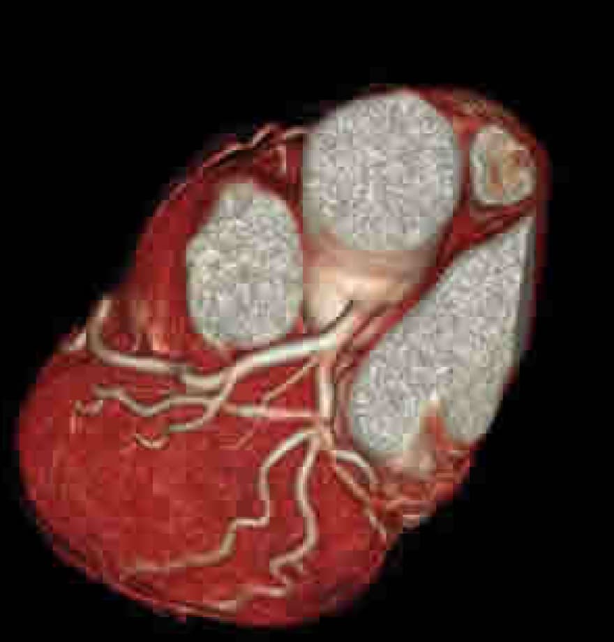 正常な心臓の血管