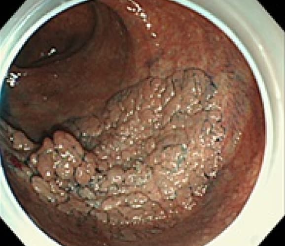 直腸の側方発育型腫瘍(早期癌)