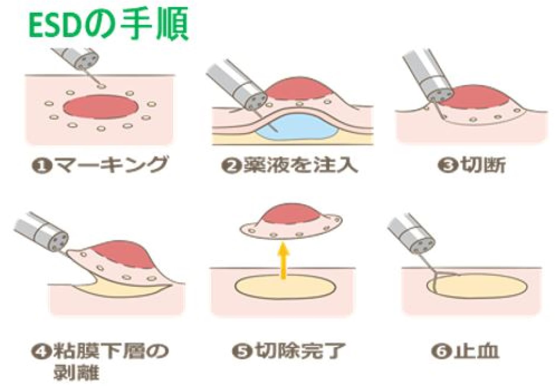 ESDの手順