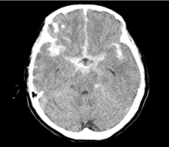 図3：くも膜下出血の頭部CT