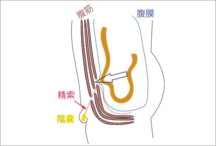 そけいヘルニアの原因のイラスト