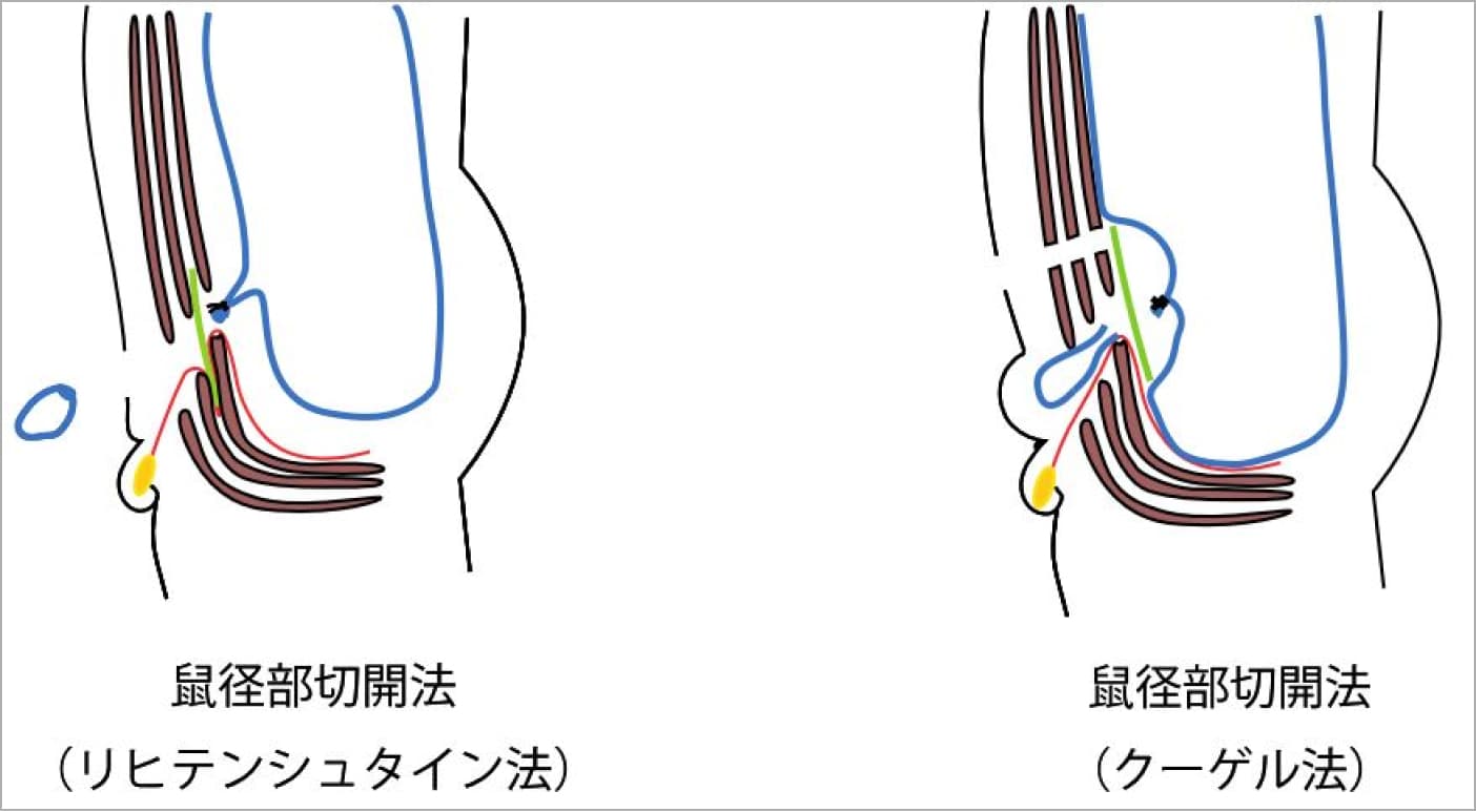 前方到達法と腹膜前修復法