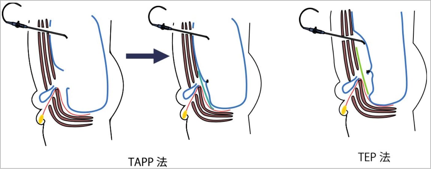 そけい部切開法と腹腔鏡手術の違い