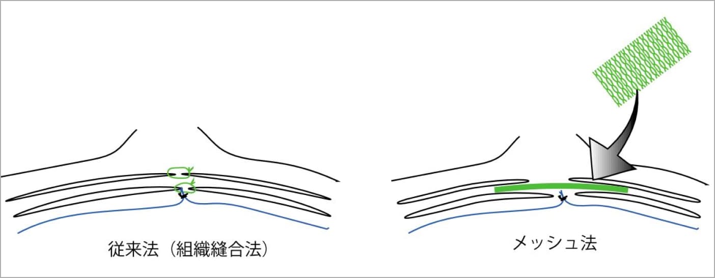 手術の方法