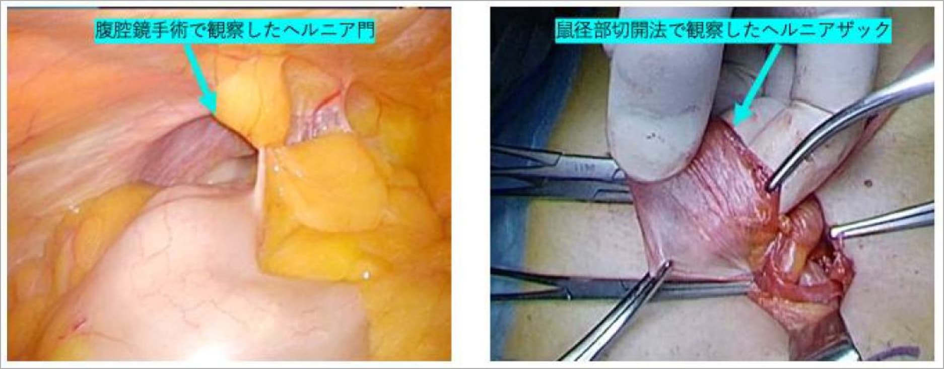 ヘルニア門とヘルニアザックの写真